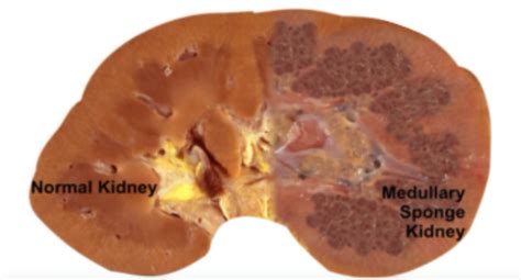 symptoms of medullary sponge kidney.